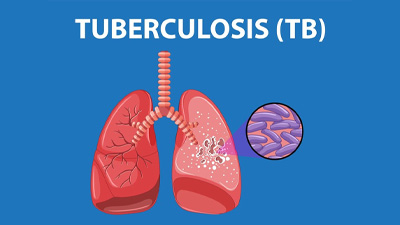 Tuberculosis: Here Are Some Of Its Types You Must Know 